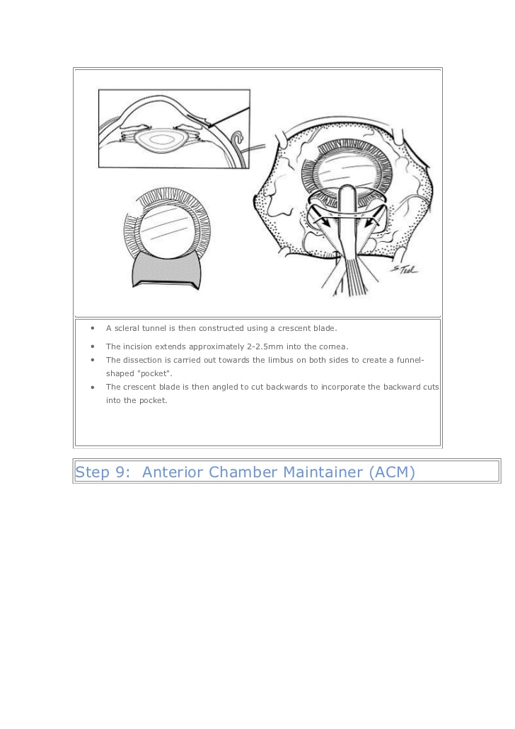 Small incision cataract surgery video download